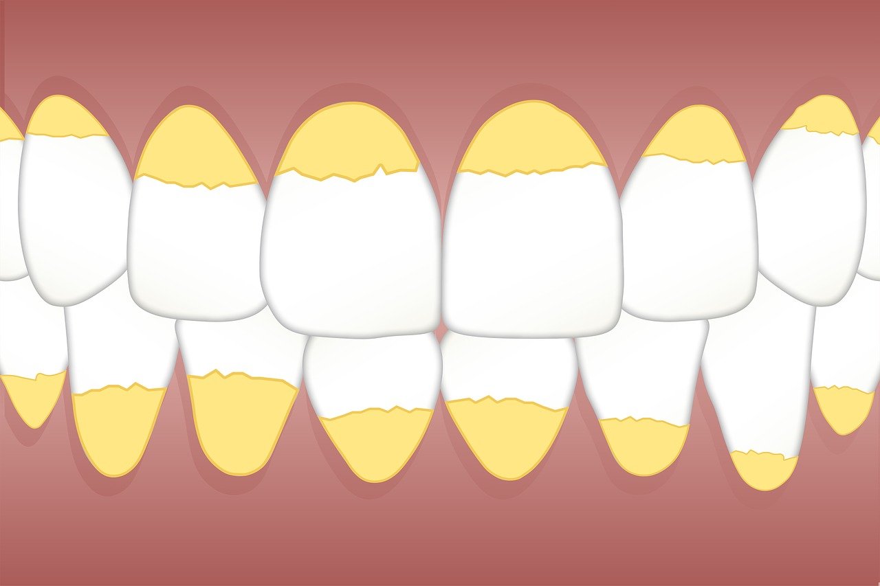 Qué es el sarro Por qué sale en los dientes ceobaza es