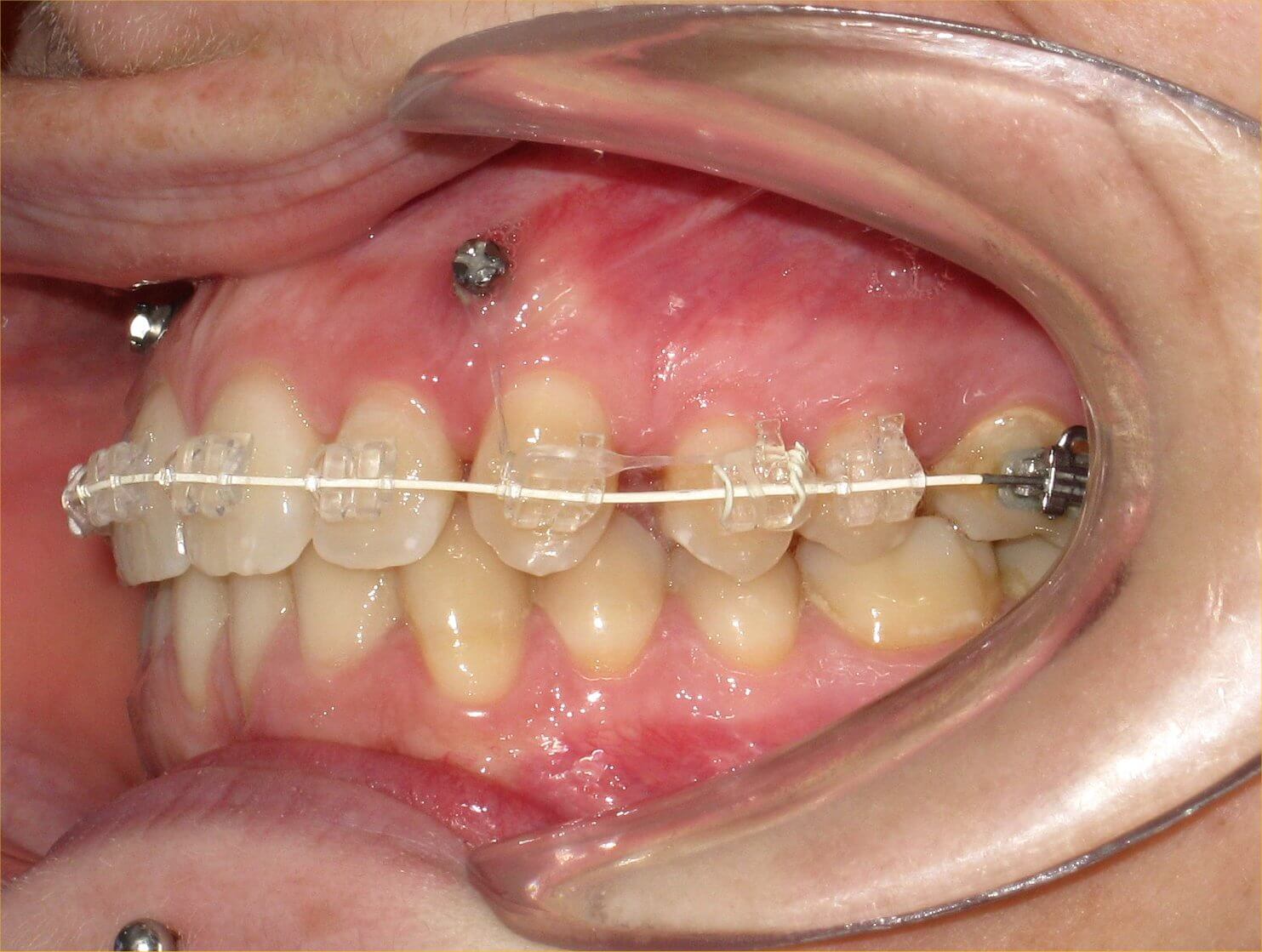 Qu Son Los Microtornillos En Ortodoncia Ceobaza Es